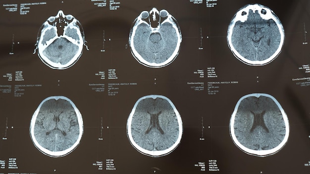 Radiographie Du Cerveau Avec Une Maladie D'accident Vasculaire ...