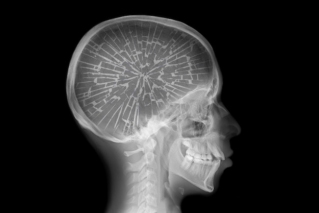 Radiographie du crâne avec cerveau cassé