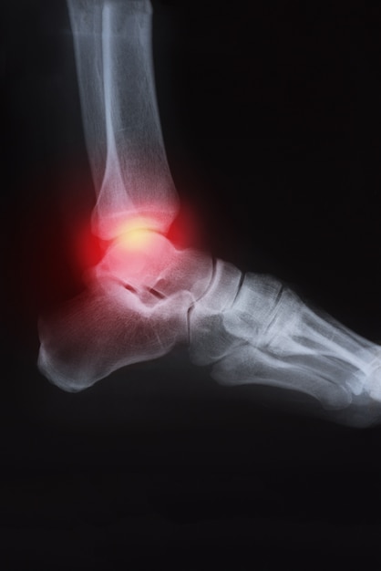 Photo radiographie du genou avec arthrite (goutte, arthrite rhumatoïde, arthrose septique)