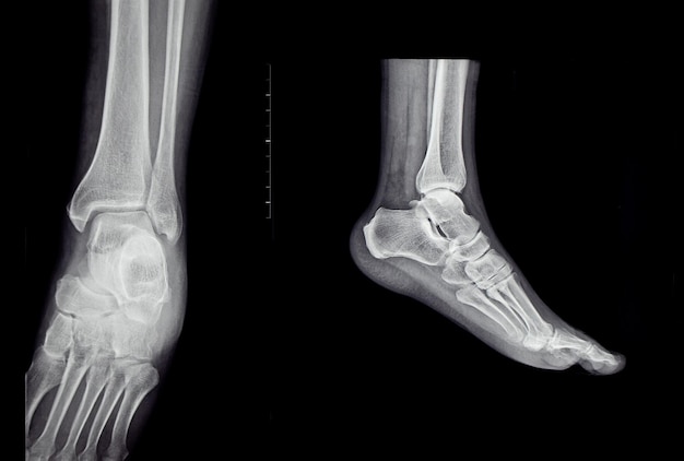 Une radiographie du pied et de la cheville humaine