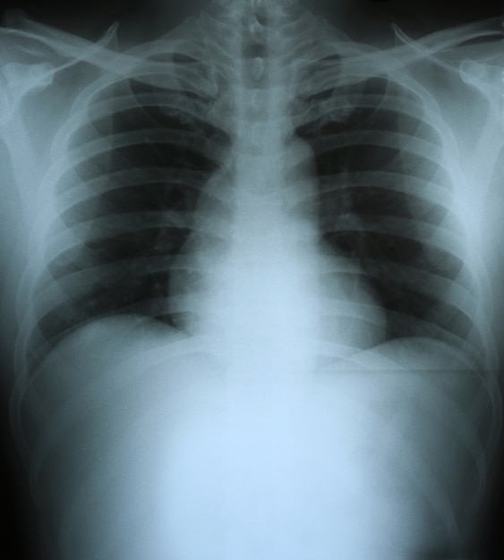 Radiographie du thorax humain (poitrine).