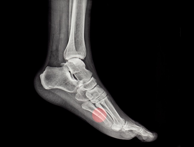 Une radiographie d'une fracture de l'os métatarsien humain