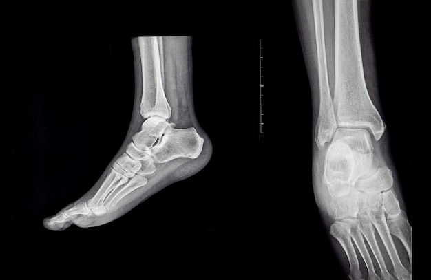 Une radiographie en gros plan de la plante du pied humain