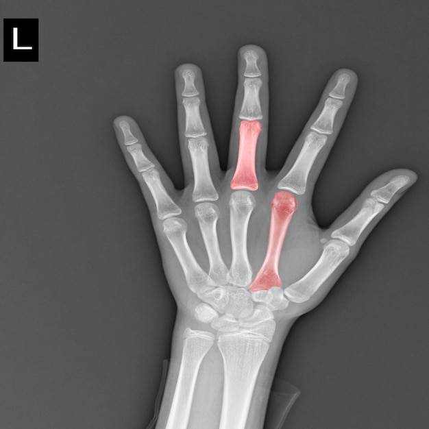 radiographie humaine de main