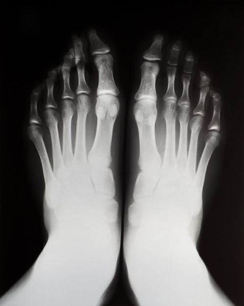 Radiographie des pieds gauche et droit.