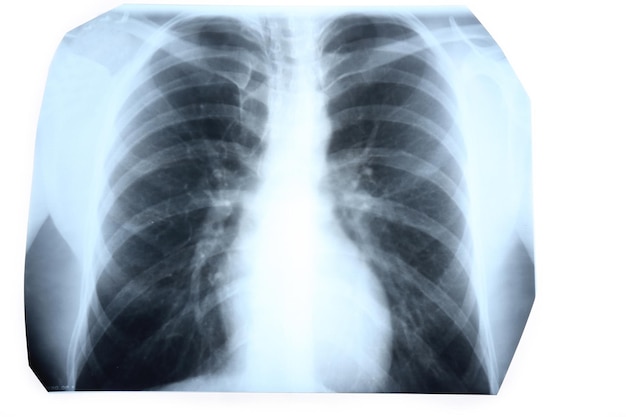 Radiographie de la poitrine humaine isolée sur blanc