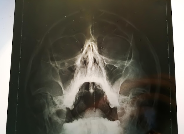 Radiographie SNP. Radiographie des sinus paranasaux avec sinusite chronique. SNP aux rayons X.