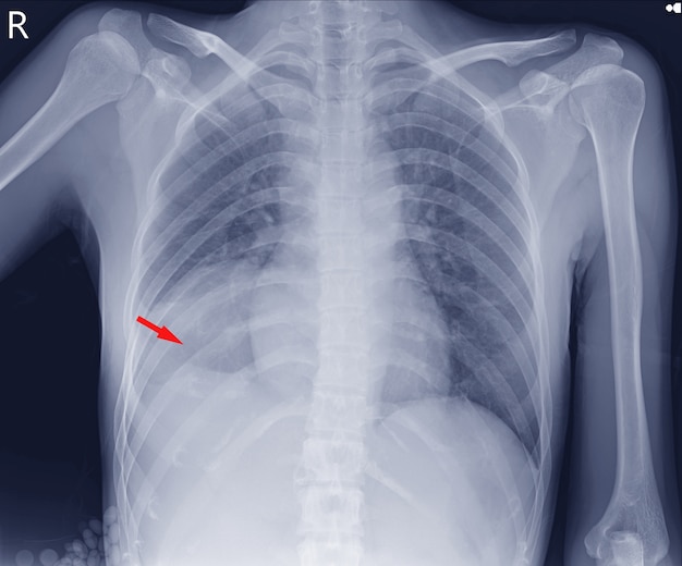 Radiographie thoracique montrant la masse Rt, champ pulmonaire inférieur probable épanchement pleural loculatéral La trachée, le cœur et le médiastin sont normaux. Les deux angles costophréniques sont clairs. Thorax osseux intact.