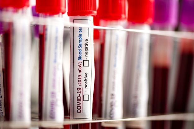 Une rangée d'échantillons de sang humain dans un laboratoire médical prêt à être testé