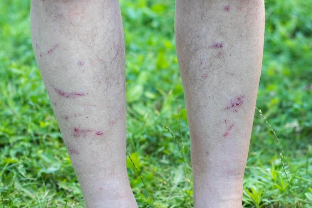 Rayures sur les jambes d'un homme debout dans le jardin sur l'herbe