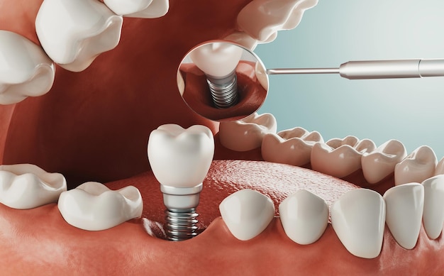 Rendering 3D d'un dentiste mettant une nouvelle dent sur une bouche