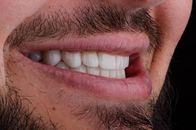 Rénovation complète du sourire masculin avec des facettes esthétiques d'apparence naturelle en céramique ultra-mince traitement dentaire