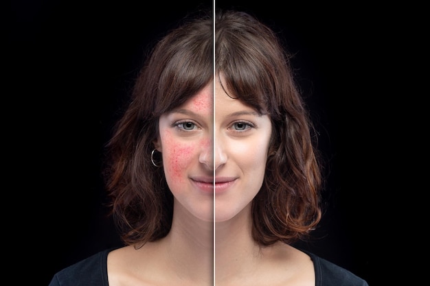 Rosacée avant et après le traitement au laser Retrait réussi du visage d'une jeune fille de race blanche