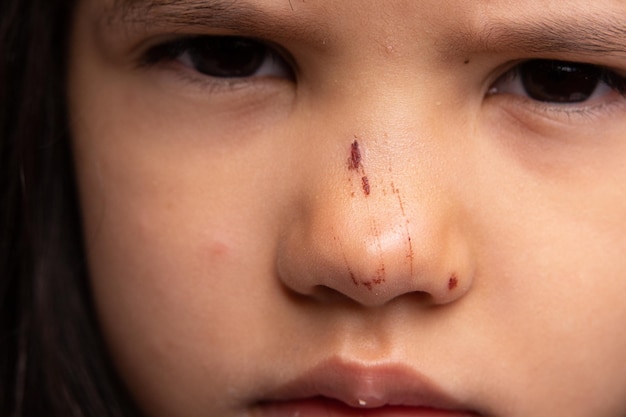 Rovigo ITALIE 22 mai 2020 gros plan d'une petite fille caucasienne avec une blessure au nez Scratch fait à la suite d'un accident domestique