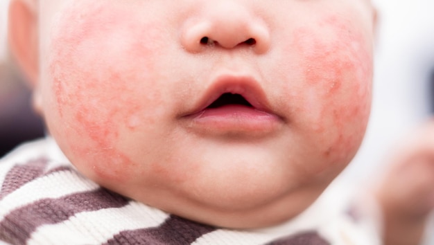 Éruption cutanée rouge avec démangeaisons due à la poussière ou à une allergie au visage du bébé allergie aux champignons maladie dermatologique peau sèche soins de santé et concept médical