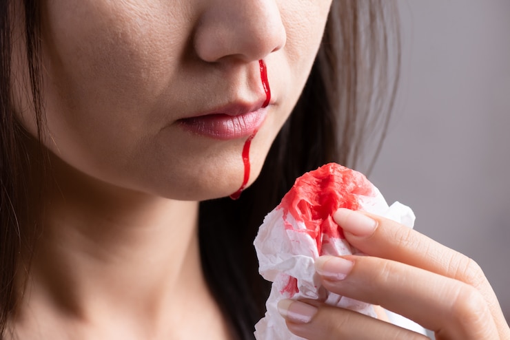 Photo saignement de nez, femme avec un nez sanglant, concept de soins de santé.