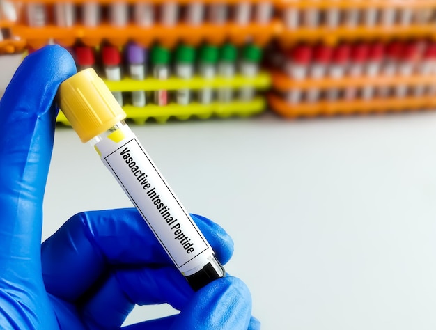 Scientifique tenant un échantillon de sang pour le test de peptide intestinal vasoactif avec fond de laboratoire.