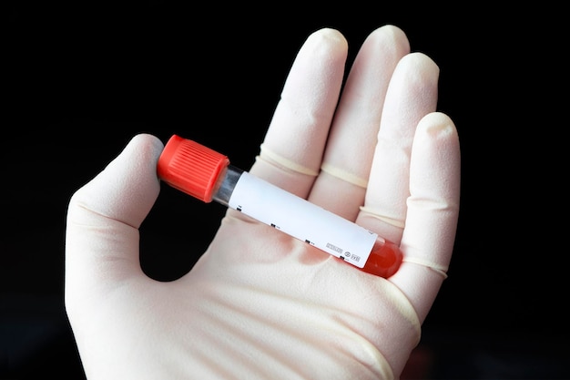 Scientifique tenant un tube à essai avec un échantillon de sang sur fond noir, gros plan. Recherche de virus. étiquette blanche vide pour le nom du patient ou le résultat du test sanguin.