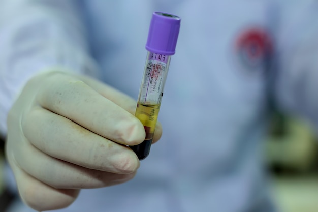 Photo les scientifiques tiennent le tube d'approvisionnement en sang du patient.