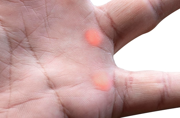 Sclérodermie sur palm isolé sur fond blanc avec un tracé de détourage