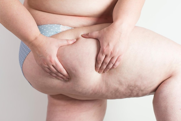 Section médiane d'une femme obèse tenant sa cuisse sur un fond blanc