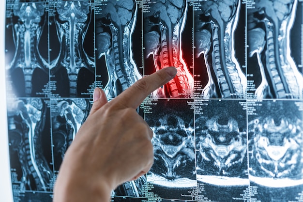 Série d'images IRM de la colonne vertébrale, de la moelle épinière avec un point douloureux rouge, de l'ostéochondrose, de la scoliose, des mains avec un concept d'imagerie par résonance magnétique
