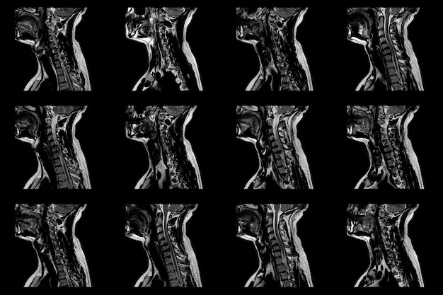 Photo série d'irm sagittales de la région du cou d'un homme de race blanche avec extrusion paramédiale bilatérale du segment c6c7 avec radiculopathie