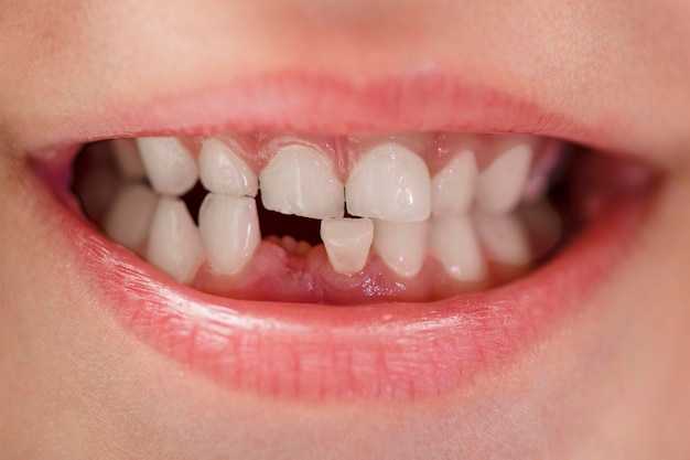 Sourire d'enfant sourire d'un enfant ans sans dent gros plan perte de dents pour enfants ca dentaire