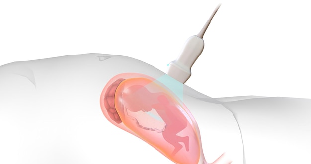 Sous la direction de l'échographie, l'aiguille pénètre dans le sac amniotique tout en évitant le fœtus
