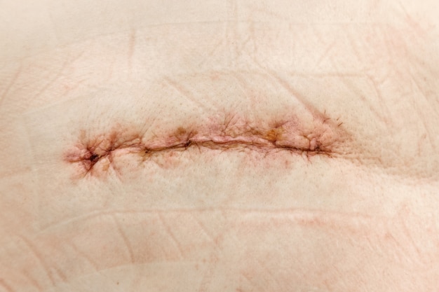 Suture de cicatrisation postopératoire sur peau humaine avec légère rougeur et traces de plâtre