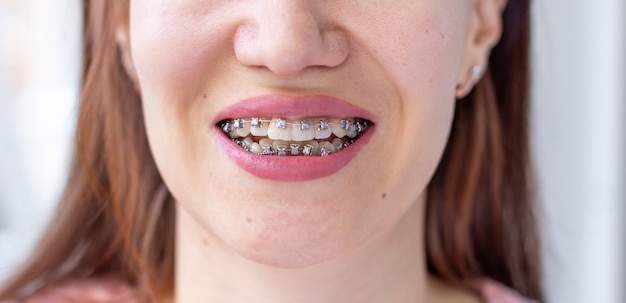 Système de support dans la bouche souriante d'une fille, macrophotographie des dents, gros plan des lèvres