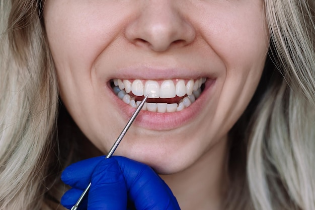 Une tache blanche sur l'émail des dents Les médecins remettent un gant bleu pointant vers les dents d'une jeune femme