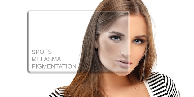 Taches brunes taches de rousseur hyperpigmentation mélasma ou chloasma