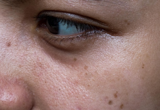 Des taches noires, des graines et des cicatrices sur le visage d'une jeune femme asiatique.