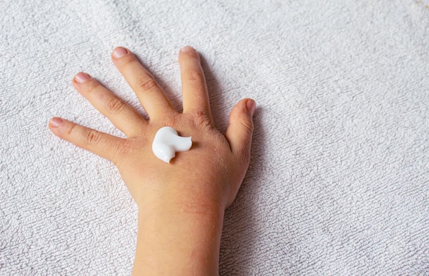 Taches rouges sur la peau des mains de l'enfantallergie des enfantsfocus sélectifnature