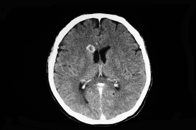 Tdm D'un Patient Souffrant D'abcès Cérébral