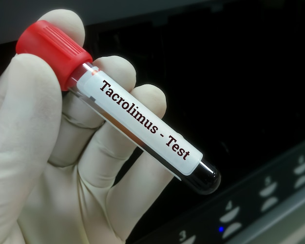 Photo le technicien tient un échantillon de sang avec un fond noir pour le médicament immunosuppresseur de test de niveau de tacrolimus