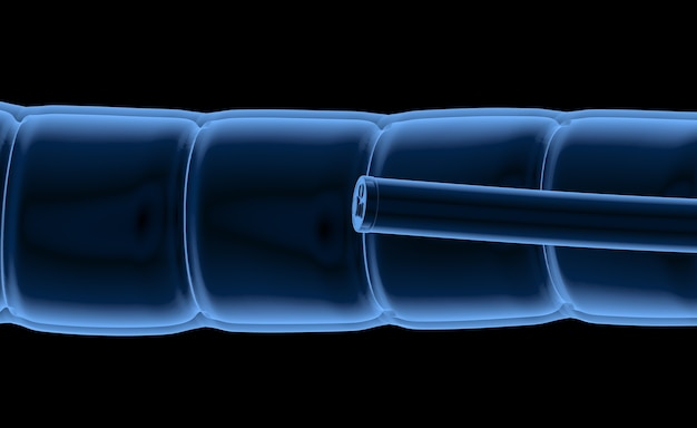 Technologie de coloscopie avec endoscope à rayons X à l'intérieur de l'intestin