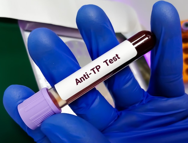 Test anti Treponema pallidum ou antiTP pour diagnostiquer une maladie sexuellement transmissible Syphilis