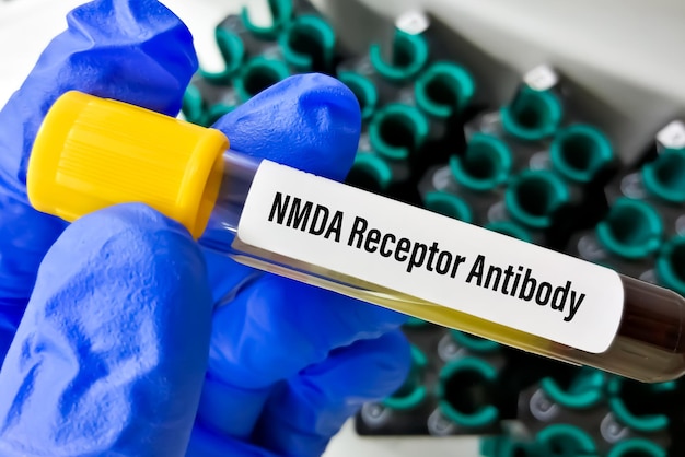 Test d'anticorps anti-récepteur NMDA ou de récepteur N-méthyl D-aspartate.