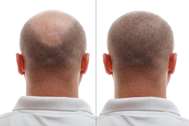 Photo la tête d'un homme chauve avant et après une greffe de cheveux, un homme qui perd ses cheveux est devenu