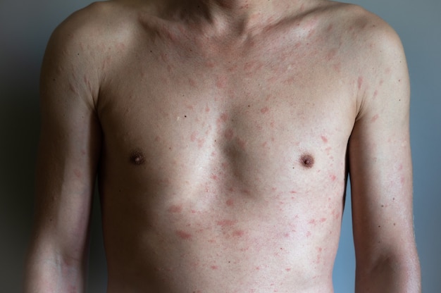 Texture d'allergie à l'eczéma atopique de la peau humaine malade. Homme présentant des symptômes d'urticaire prurigineuse.