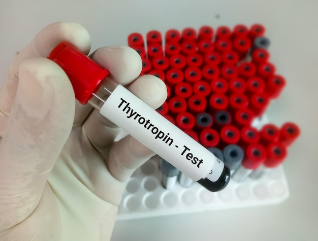 Photo thyrotropine ou tsh diagnostic d'hyperthyroïdie ou d'hypothyroïdie d'un patient