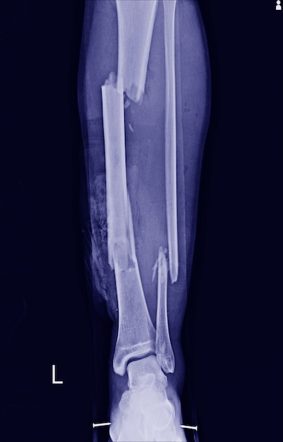 Photo tibia et fibulaire de jambe à fracture multiple