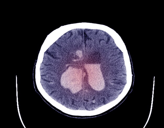 Photo tomodensitométrie (ct ou cat) du cerveau pour évaluer l'avc hémorragique
