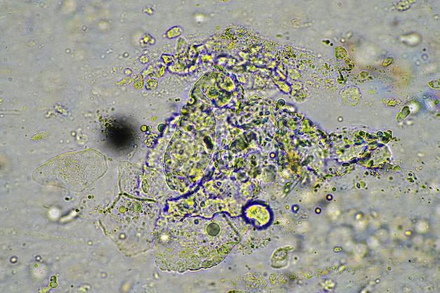 Photo toux de mucus et de flegme d'une infection thoracique d'une infections virale et bactérienne en la regardant au microscope avec des cellules et des micro-organismes bactéries et cellules de la peau