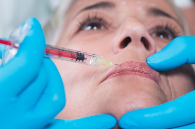 Traitement du visage par injection d'hyaluronane