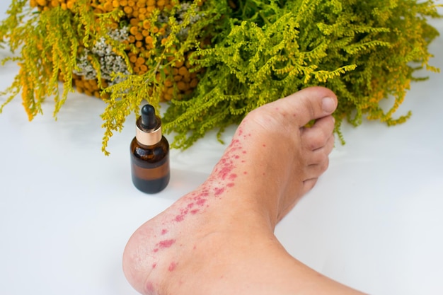 Photo traitement des maladies infectieuses du pied avec des huiles et des herbes médicinales champignon du pied et éruption allergique