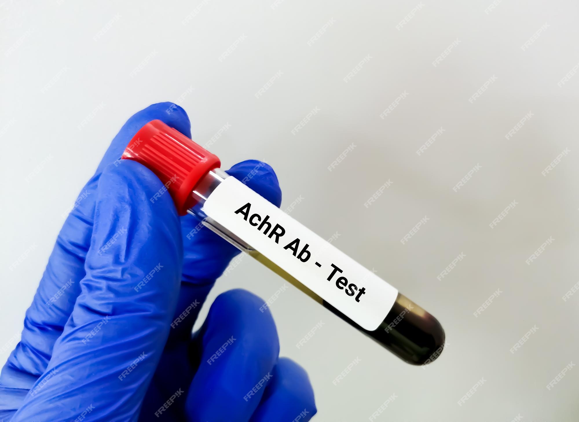 Anticorps Anti Recepteur De L'acétylcholine 0.20 Nmol/l Tube à Essai Avec Du Sang Pour Le Test D'anticorps Anti-achr Ou