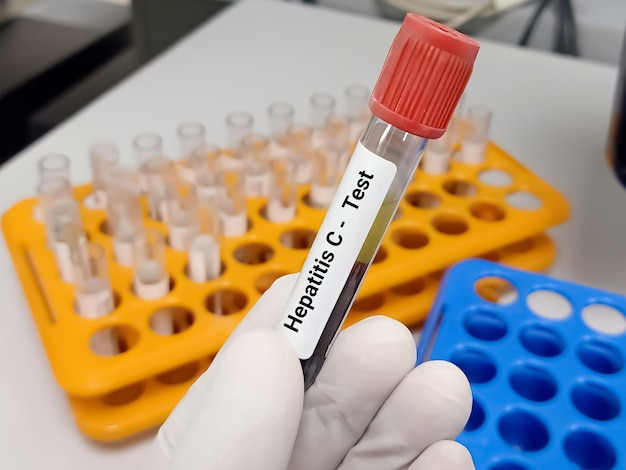 Tube à essai avec échantillon de sang pour le test du virus de l'hépatite C (VHC), anti-VHC. Un concept de test médical